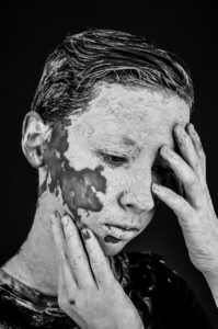 ニキビ跡の色素沈着を改善するためのハイドロキノンの効果とは？